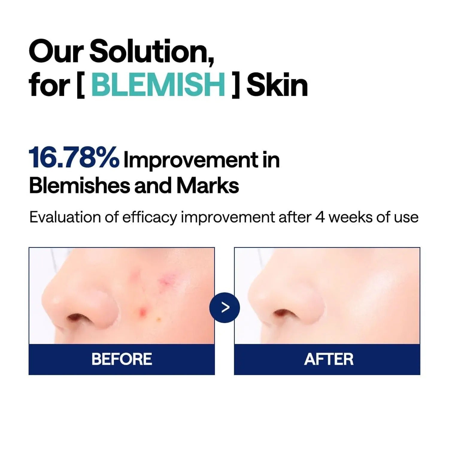 Korean Skin Care — Madecassoside Toner Pads - with Centella Asiatica to Treat Blemishes and Improve Uneven Skin Tone - Vegan Gauze Fabric